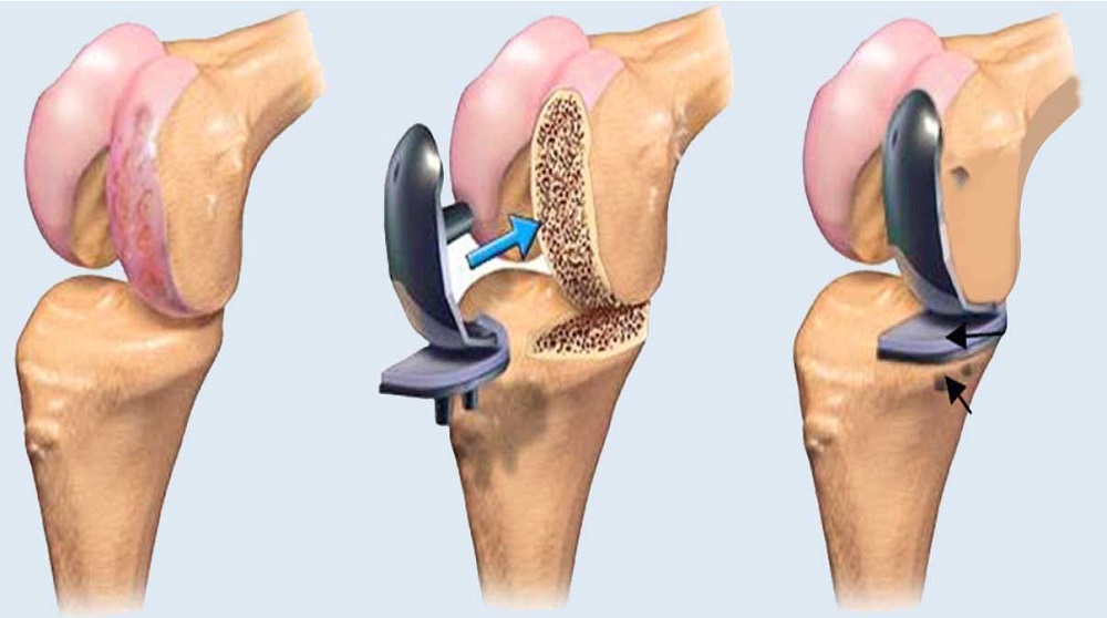 knee replacement in panvel