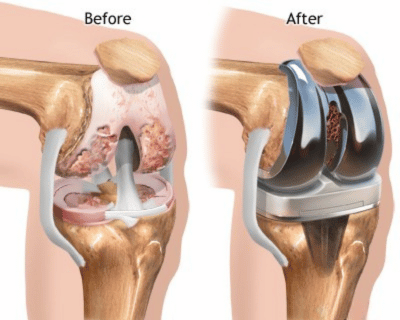 Knee replacement before after