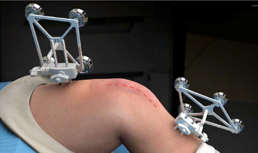 robotic knee replacement by Dr. Dr. Kunal Makhija
