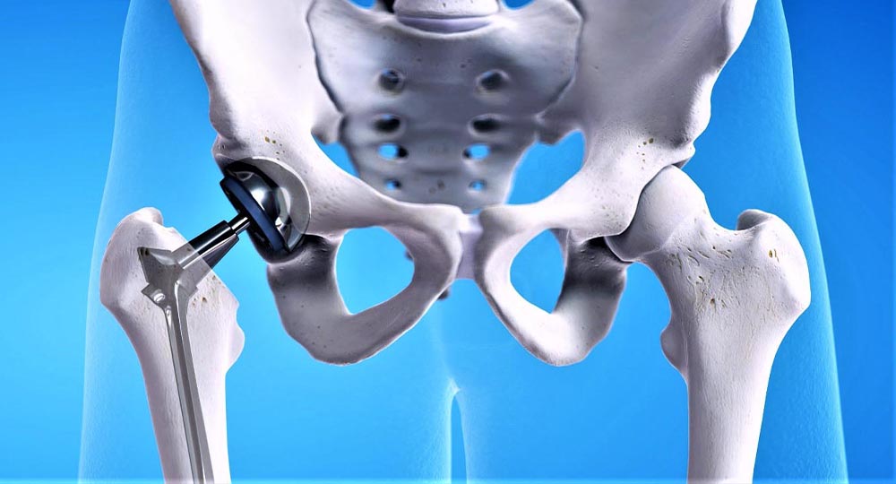 Robotic Knee Replacement surgery in panvel, navi mumbai